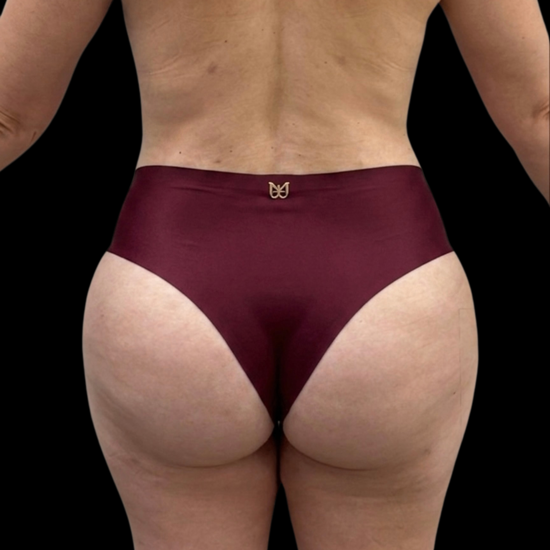 Depois — Lipo + Modelagem de Glúteos