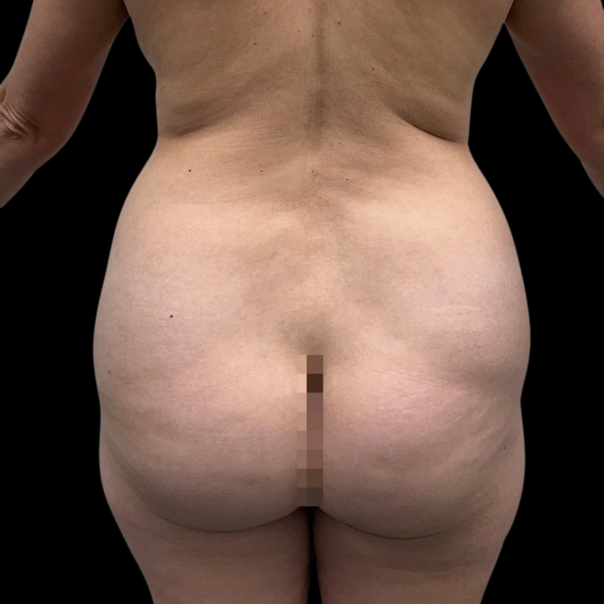Antes — Lipo + Modelagem de Glúteos