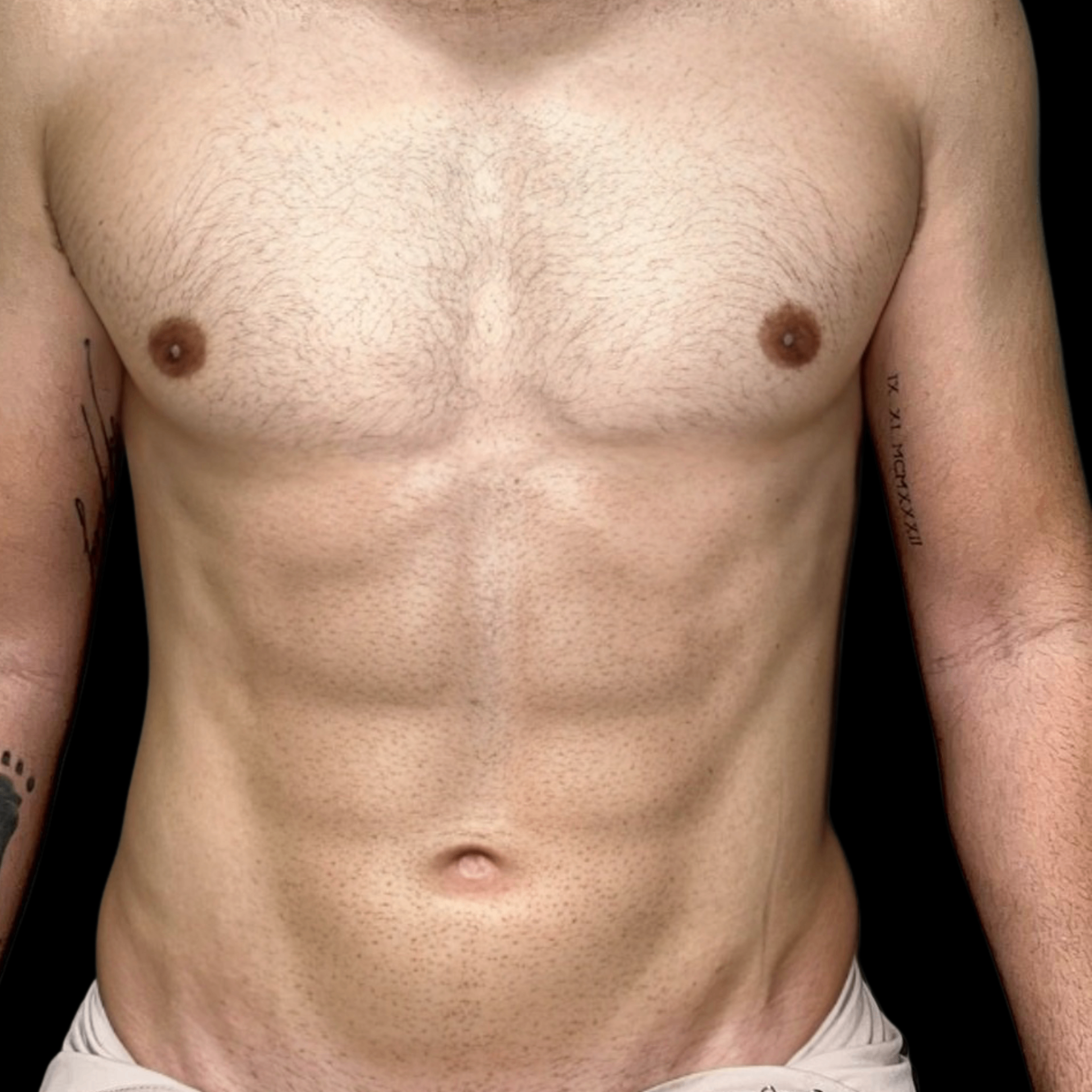 Depois — Lipo Masculina + Definição Abdominal