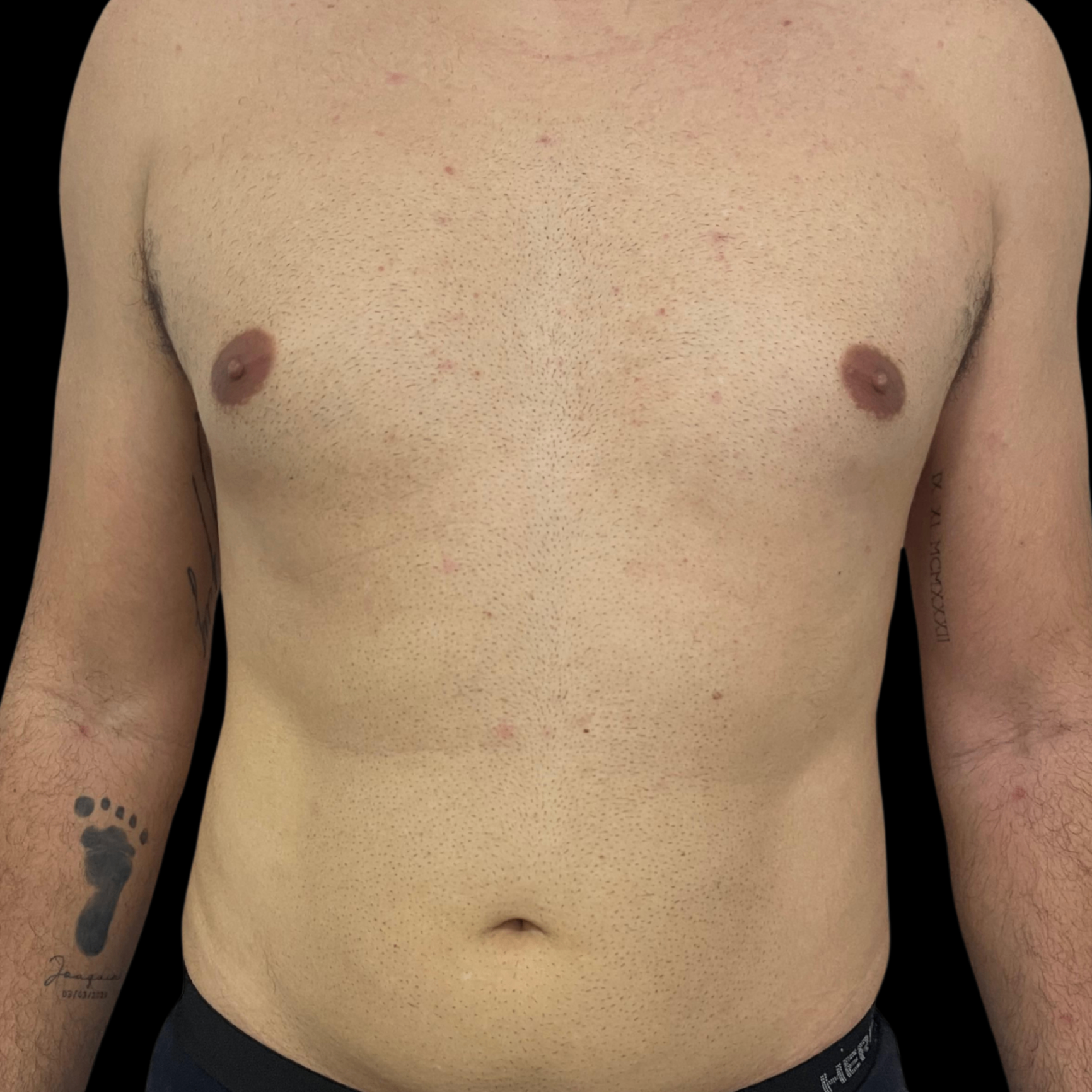 Antes — Lipo Masculina + Definição Abdominal